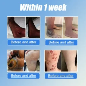 JORONDY® VitaGluco Diabetes Treatment Cream