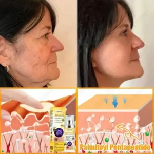 JORONDY® Bee Venom Senile Purpura Cream