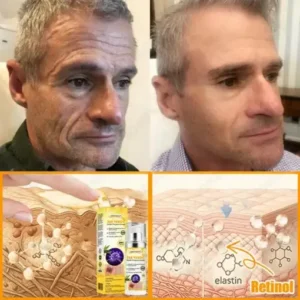 JORONDY® Bee Venom Senile Purpura Cream