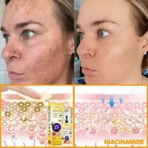 JORONDY® Bee Venom Senile Purpura Cream