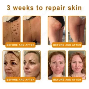 JORONDY® Bee Venom Senile Purpura Cream