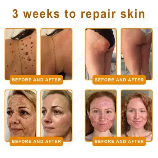 JORONDY® Bee Venom Senile Purpura Cream