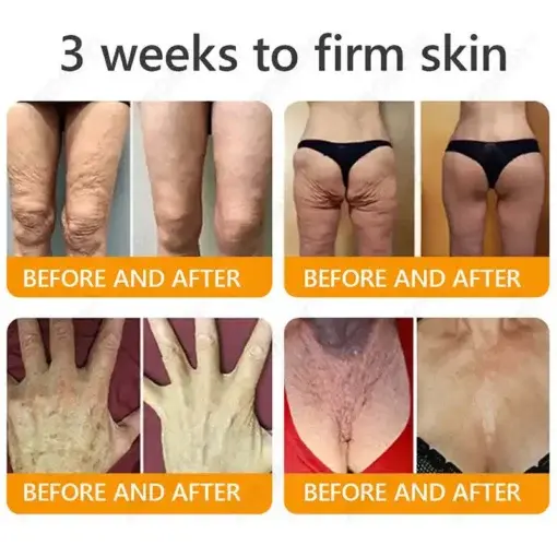 JORONDY® Bee Venom Senile Purpura Cream