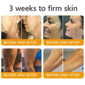 JORONDY® Bee Venom Senile Purpura Cream