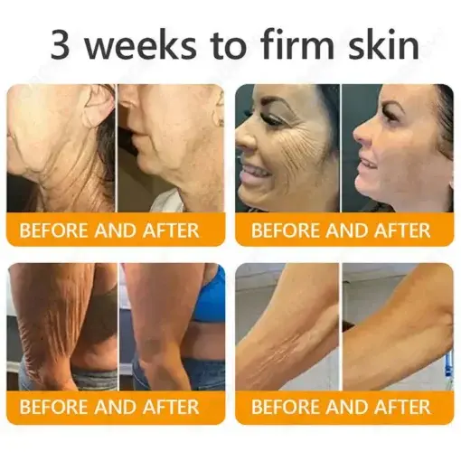 JORONDY® Bee Venom Senile Purpura Cream