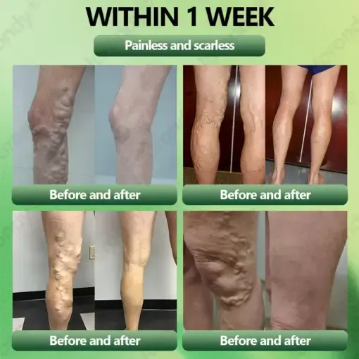 JORONDY® Horse Chestnut Vein Cream