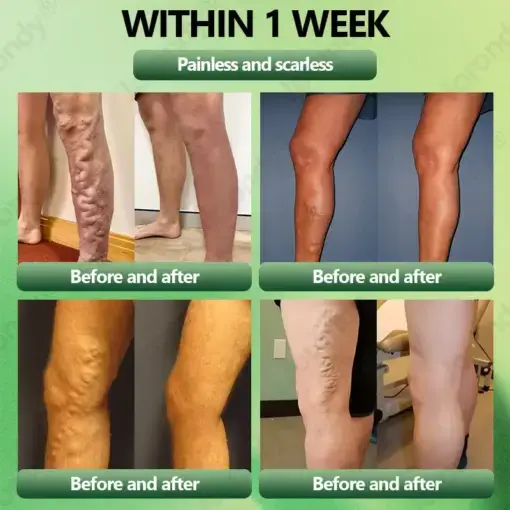 JORONDY® Horse Chestnut Vein Cream