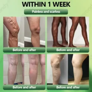 JORONDY® Horse Chestnut Vein Cream