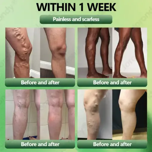 JORONDY® Horse Chestnut Vein Cream