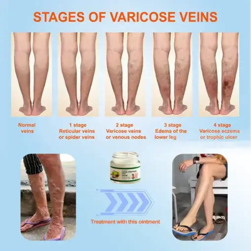 JORONDY® Horse Chestnut Vein Cream