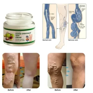JORONDY® Horse Chestnut Vein Cream