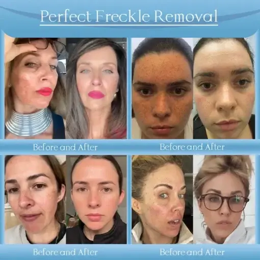 Jorondy® Anti-Falten-Creme zur Faltenreduzierung, Hautstraffung und Aufhellung