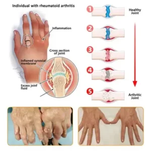 Jorondy® Bee Venom Pain-Relief Bone Healing Spray