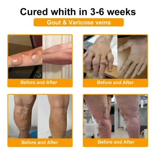 Jorondy® Bee Venom Pain-Relief Bone Healing Spray