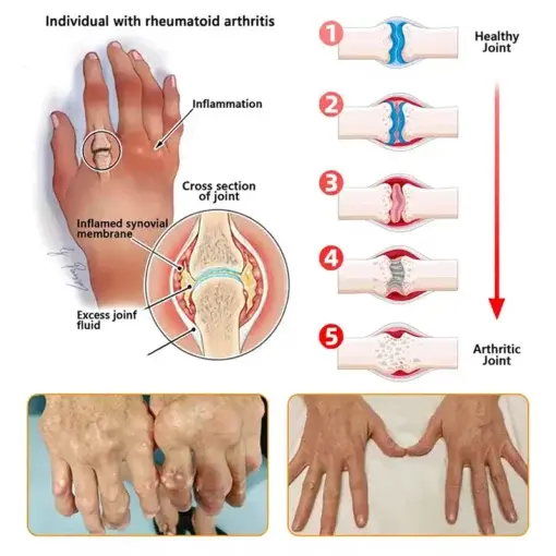 Jorondy® Bee Venom Pain-Relief Bone Healing roll-on-On