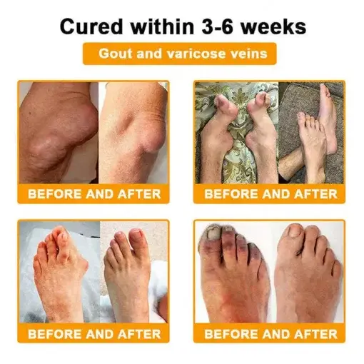 Jorondy® Bee Venom Pain-Relief Bone Healing roll-on-On