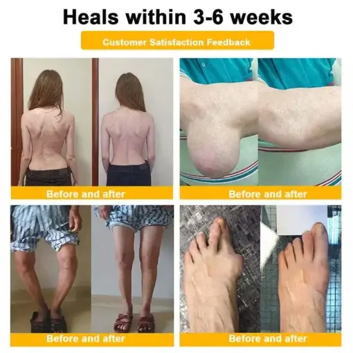 Jorondy® Bee Venom Pain-Relief Bone Healing roll-on-On