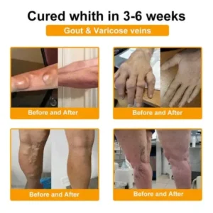 Jorondy® Bee Venom Pain-Relief Bone Healing roll-on-On