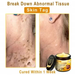 Jorondy® Skin Treatment Cream